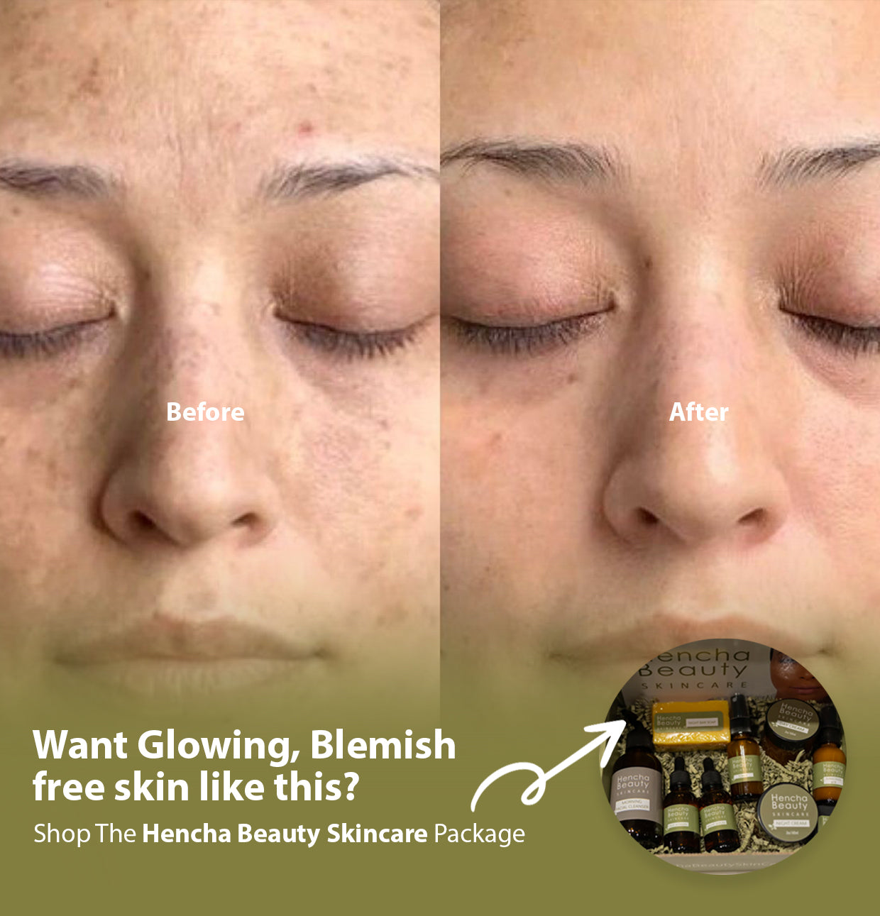 Here's Why You Need The Hencha Beauty Skincare Package.